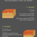 burn injuries infographic